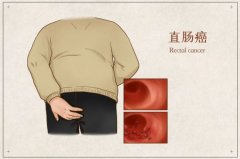直肠超低位恶性肿瘤能否保肛成功？省中医院多学科协同再次刷新记录